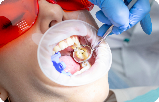 The Dental caries