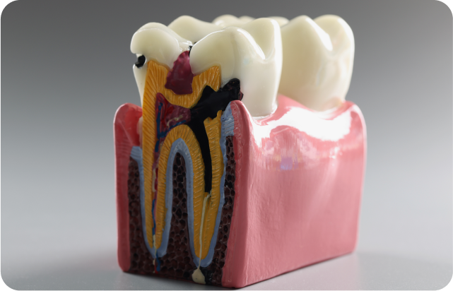 dental caries