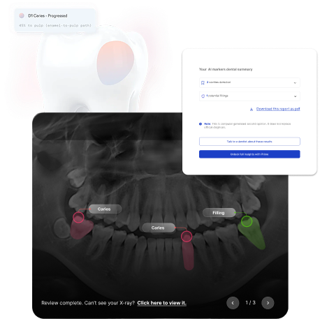 AI dental clinical assistant interface showing radiograph analysis and second opinion insights