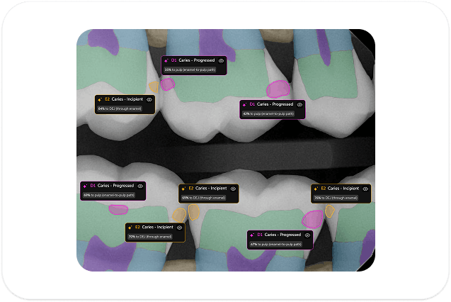 Dental AI radiograph with highlighted findings and overlays