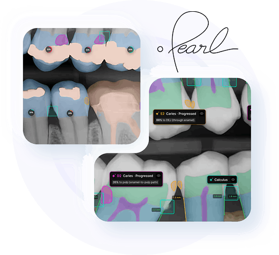 Pearl AI dental radiograph analysis collage with highlighted findings