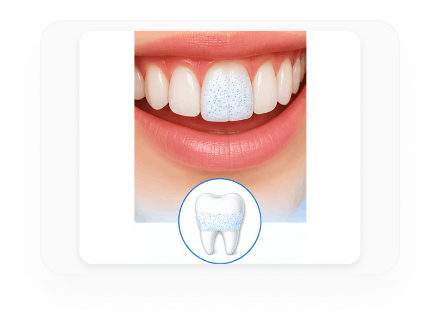 Strip molding to enamel