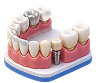 Full mouth reconstruction dental model