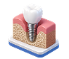 Dental implant case illustration