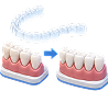 Orthodontic alignment before and after