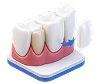 Veneers and laminates dental illustration